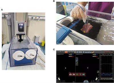 Effect of Baseline Impedance in Radiofrequency Delivery on Lesion Characteristics and the Relationship Between Impedance and Steam <mark class="highlighted">Pops</mark>